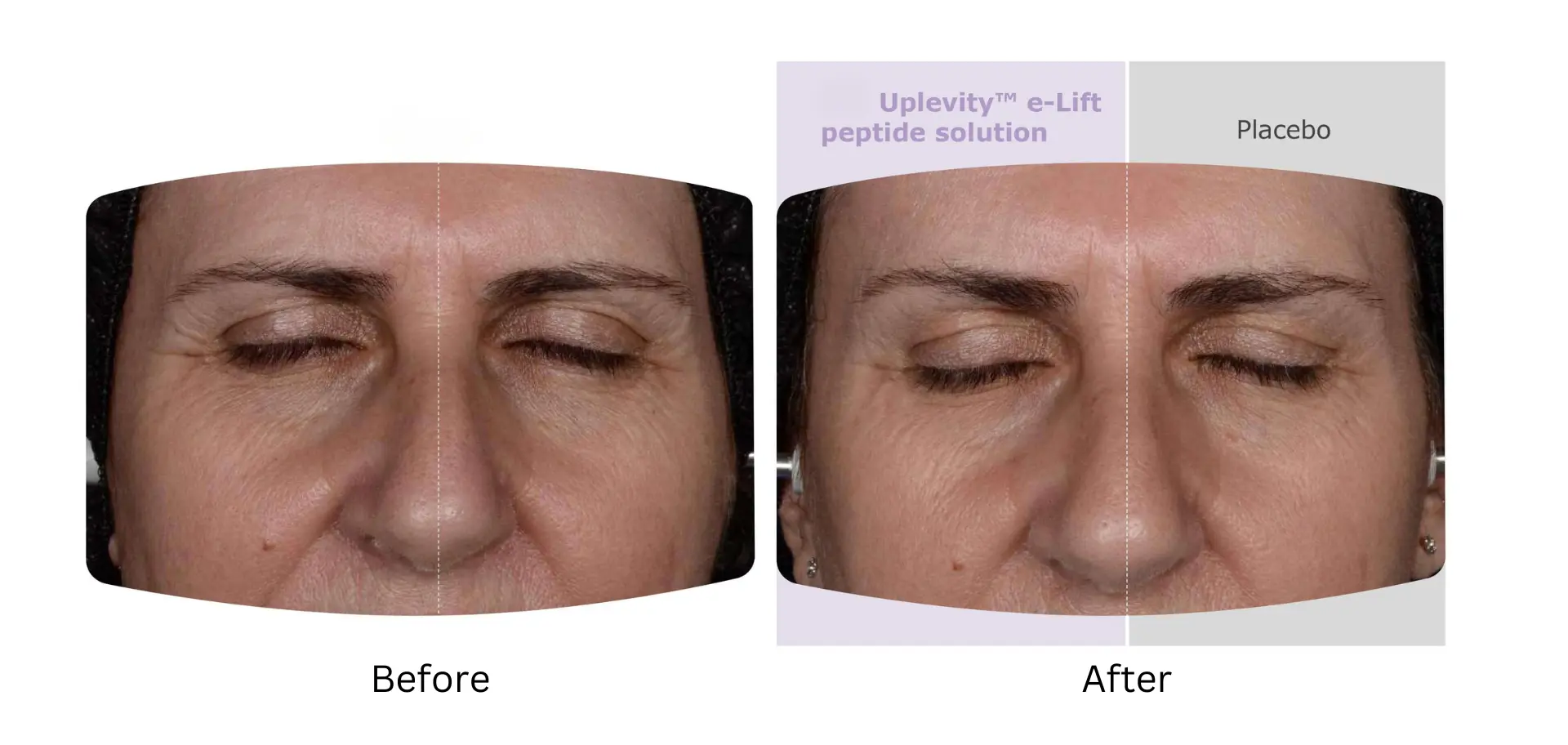 Lifting effect after using Uplevity™ e-Lift Peptide compared to placebo